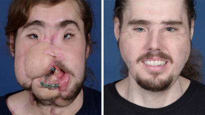 Cameron Underwood: el joven al que un trasplante de rostro le devolvió la sonrisa después de un intento de suicidio